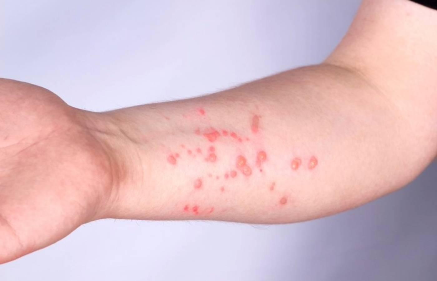 Mpox: Brasil registra 140 casos em 2026